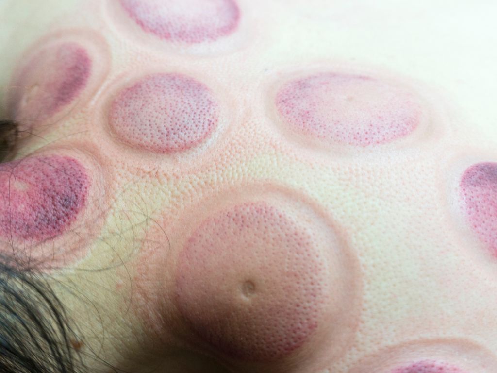 Diagnostic Cupping Course